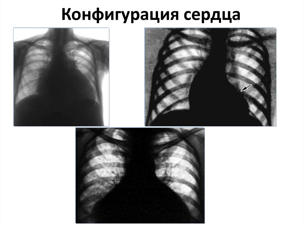 Несколько увеличены. Трапециевидная конфигурация сердца рентген. Митральная конфигурация сердца на рентгенограмме при. Митральная форма сердца на рентгенограмме. Митральная и аортальная конфигурация.