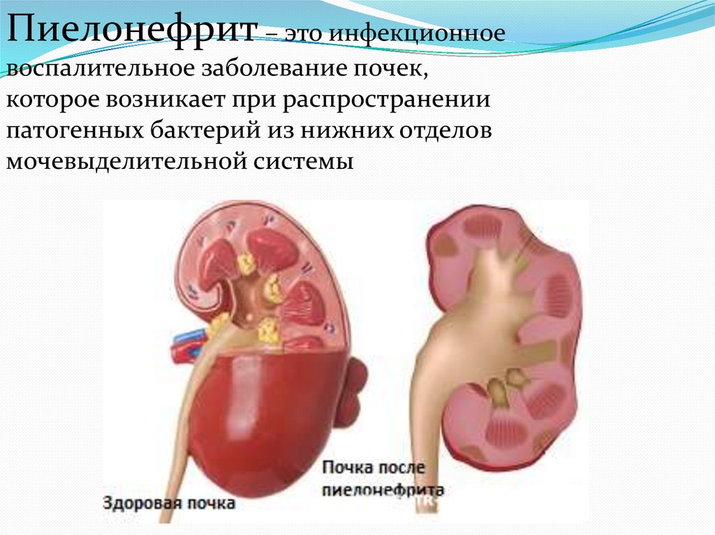 Хронический пиелонефрит гломерулонефрит