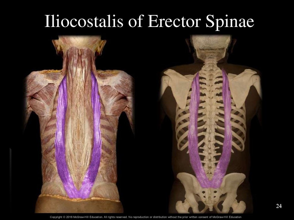 Iliocostalis of Erector Spinae
