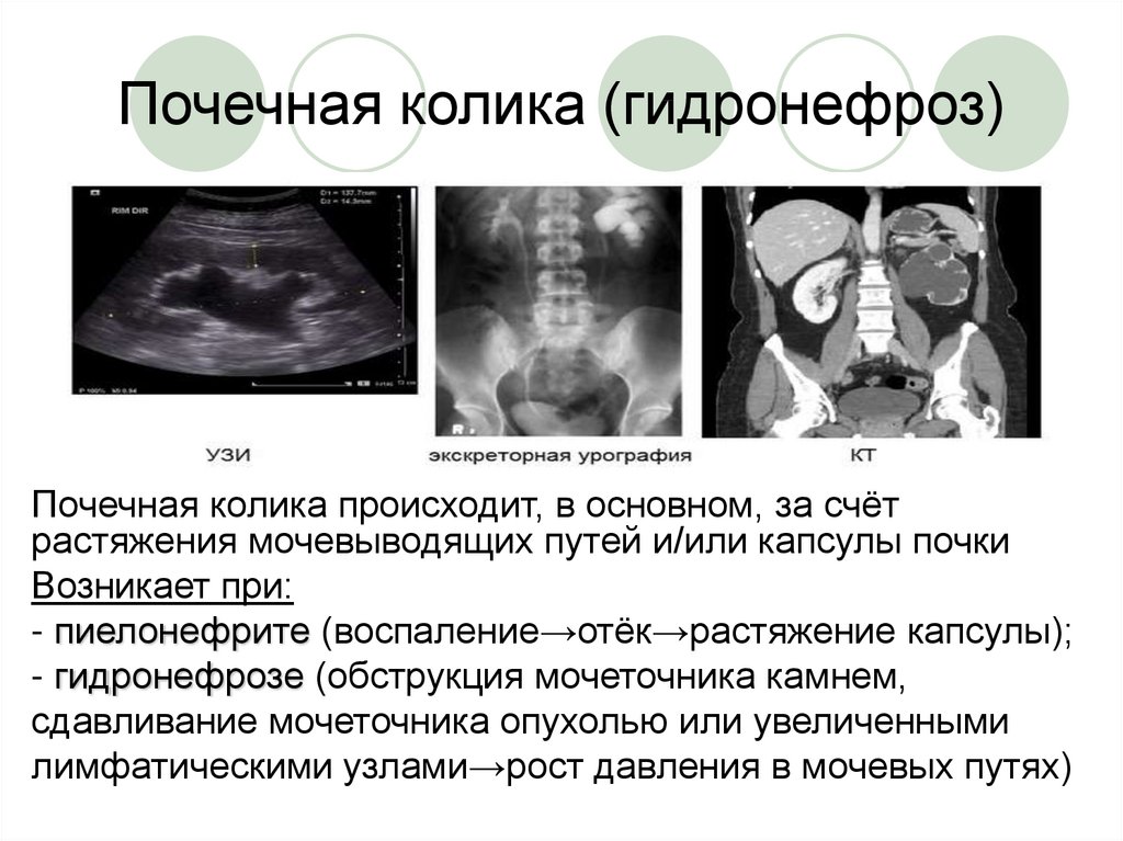 Гидронефроз презентация урология