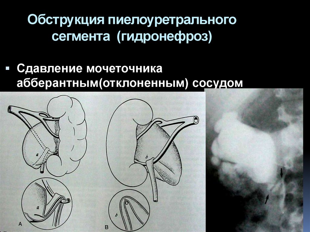 Гидронефроз презентация детская хирургия