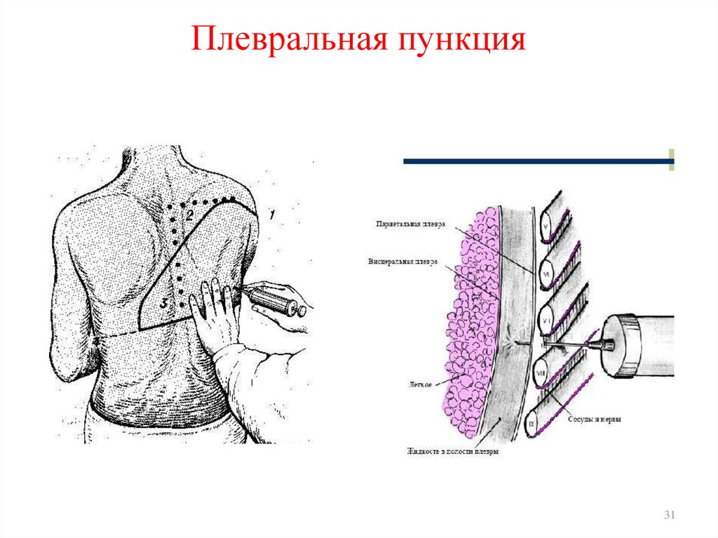 Экссудативный плеврит пункция