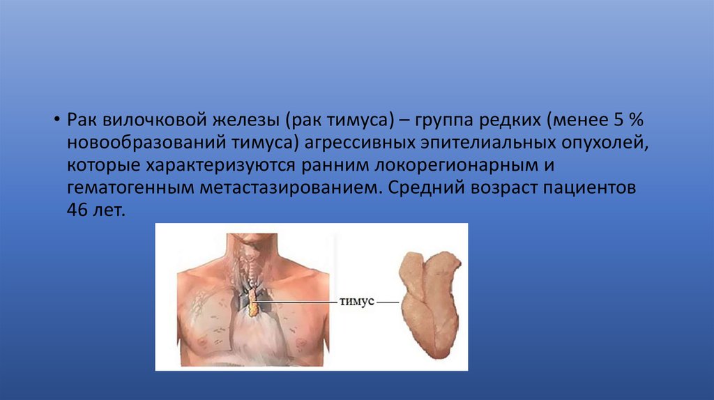 Лучевая железа. Опухоль вилочковой железы. Злокачественные опухоли тимуса. Вилочковая железа опухла.