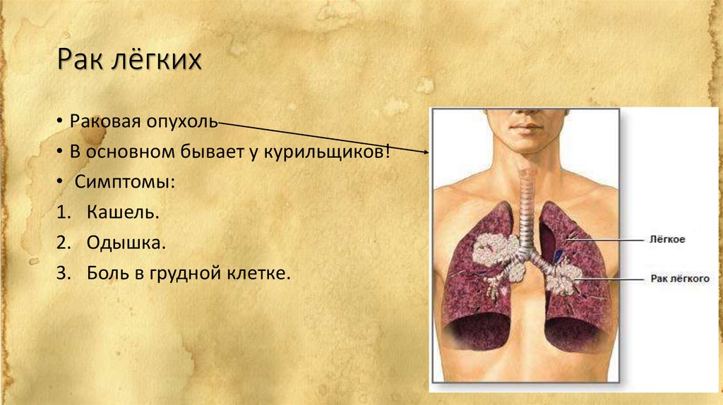 Заболевание органов дыхания 8 класс презентация