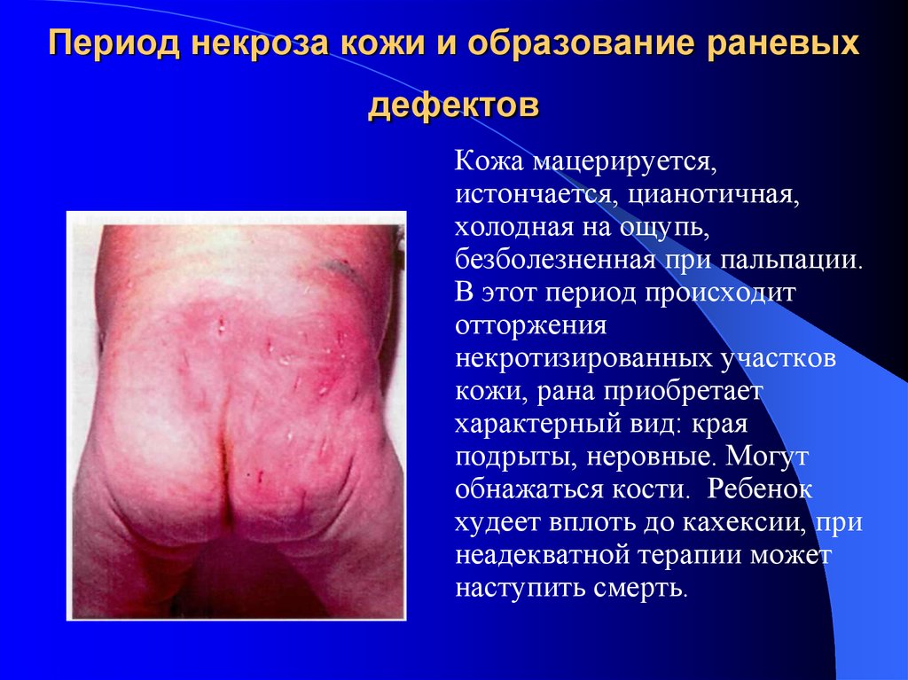Период некроза кожи и образование раневых дефектов