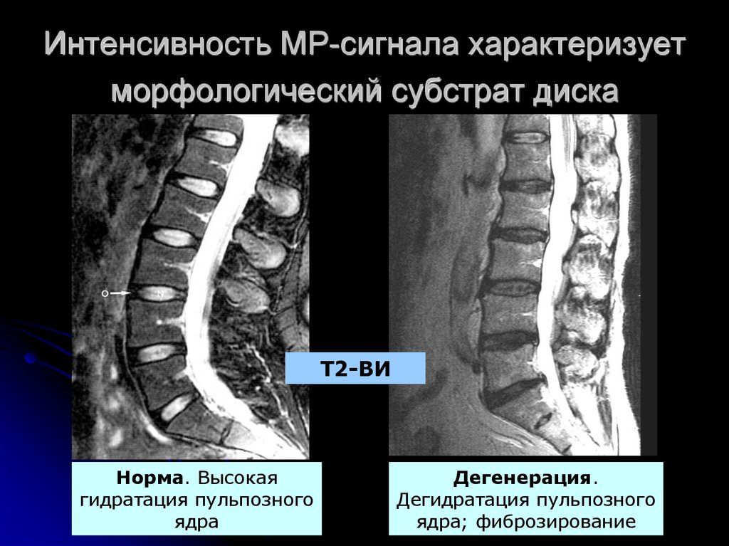 Дегидратация позвоночника. Интенсивность МР сигнала. Понижения интенсивности сигнала от межпозвонковых дисков. МР сигнал межпозвонковых дисков снижена. Снижение интенсивности МР-сигнала на т2 ви что это.