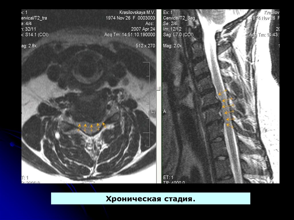 Медианная с5 с6. Дискоостеофитический комплекс мрт. Шейный остеохондроз на мрт. Грыжа шейного отдела мрт. Экструзия диска мрт.