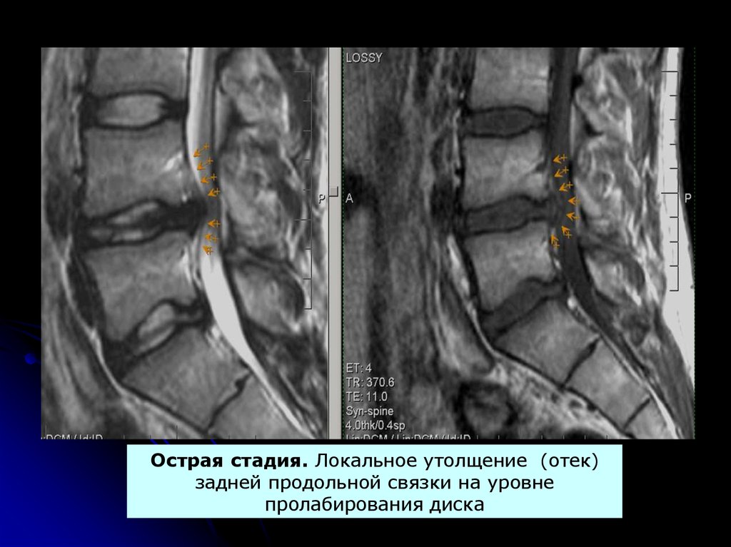 Мрт картина дегенеративно дистрофических изменений