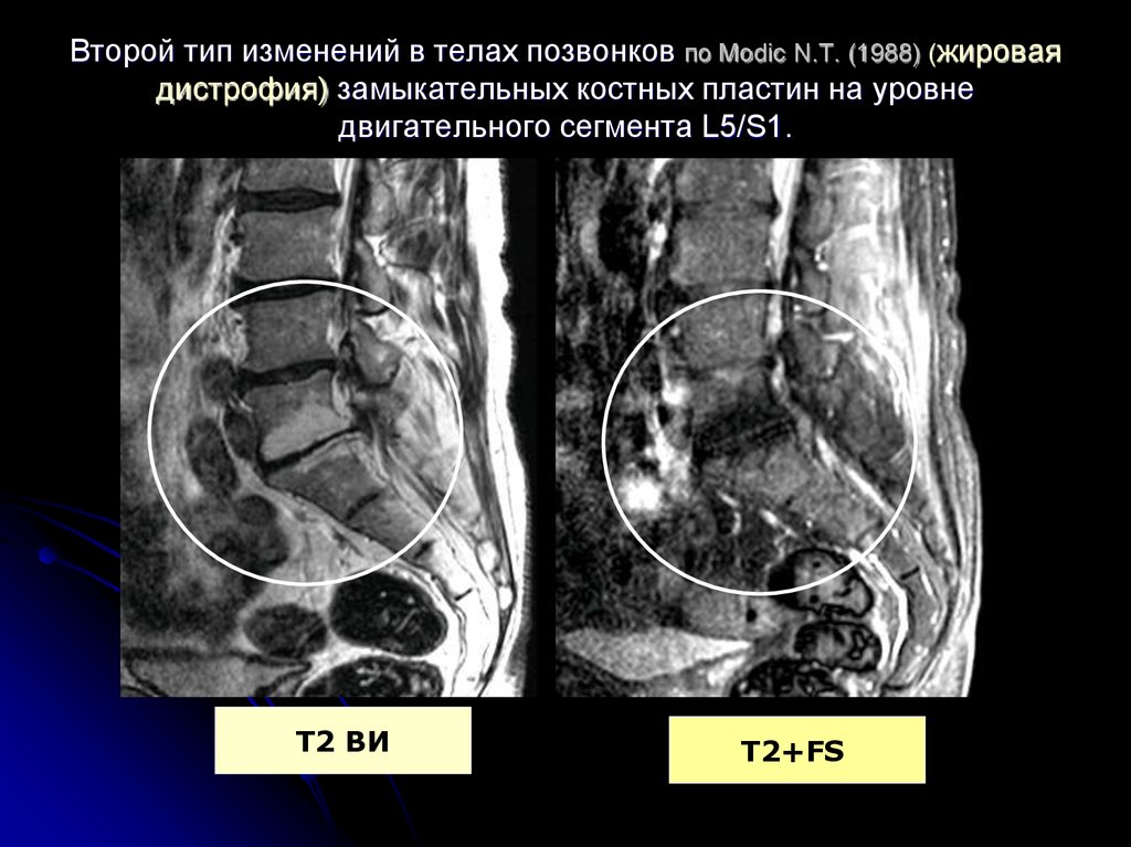 Теле л. Жировая дегенерация Modic тип2. Жировая дегенерация костного мозга по типу Modic 2. Участки жировой дегенерации. Жировая дегенерация костного мозга.