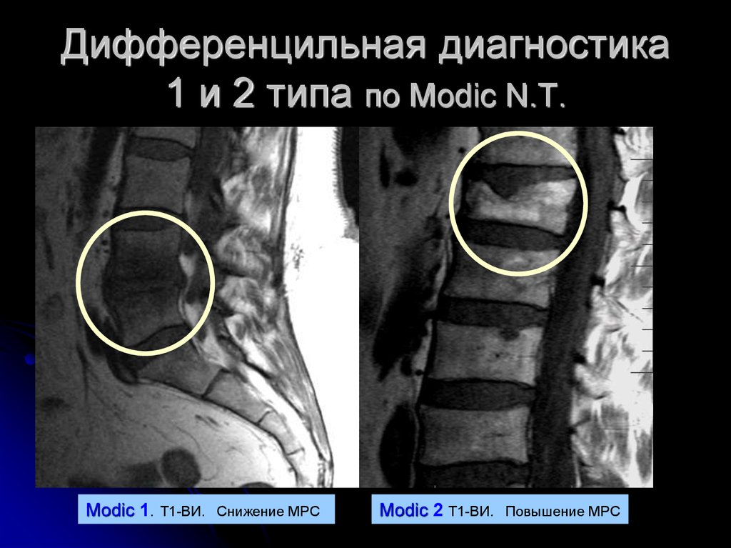 Модик 1. Modic Тип 2. По типу модик 1. Modic спина.