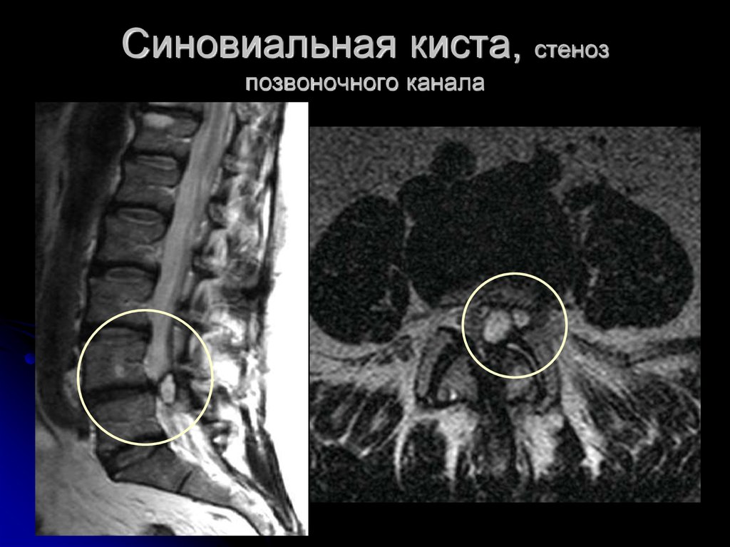 Киста поясничного