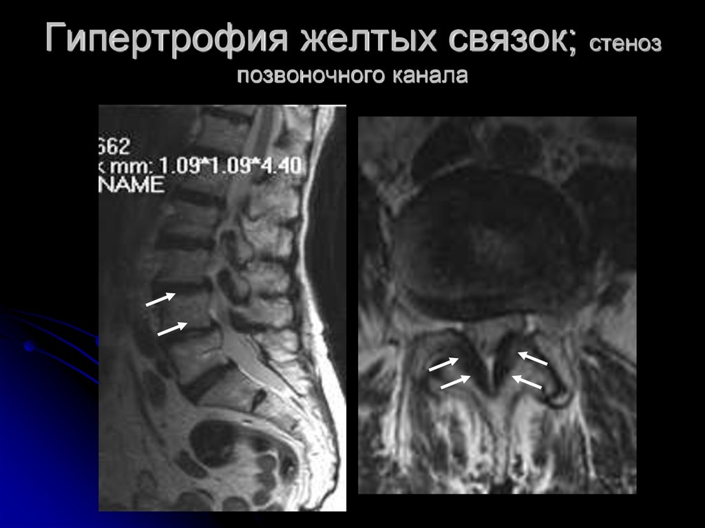 Желтые связки. Желтые связки позвоночника гипертрофированы. Гипертрофия желтых связок. Гипертрофия желтых связок мрт. Гипертрофия желтой связки позвоночника.