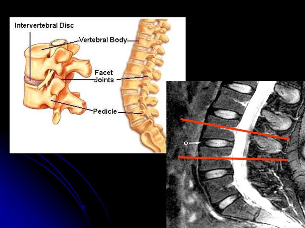 Спинные диски. Межпозвонковый диск пролабирует кзади. Гипоинтенсивный очаг на т1 и т2 МР сигнал в позвонке. Мясо с внутренней стороны позвоночника. Изменения по типу Modic 1 в костном мозге имеют МР-сигнал.