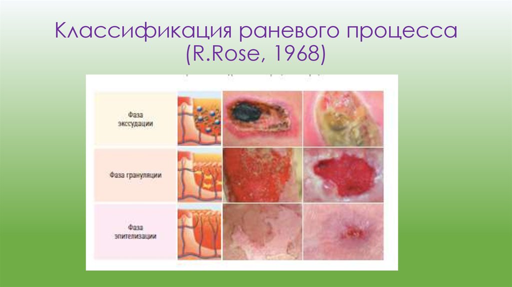 Классификация раневого процесса (R.Rose, 1968)