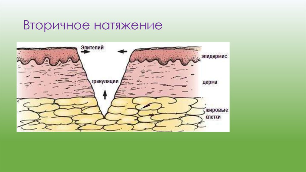 Первичное и вторичное натяжение раны