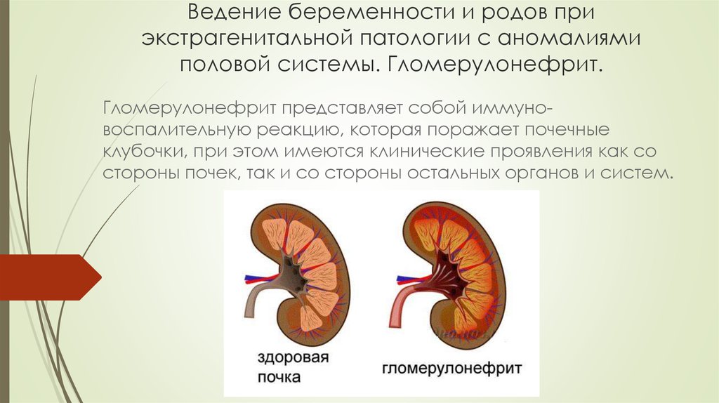 Для ультразвуковой картины почек при остром гломерулонефрите будет характерно