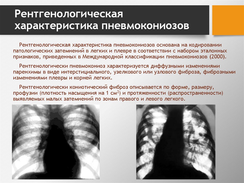 Рентгенологическая характеристика пневмокониозов