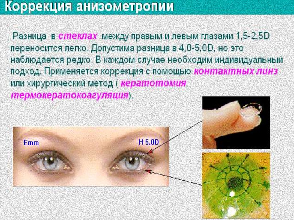 Аккомодация офтальмология презентация