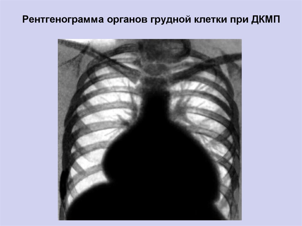 Тень сердца расширена. Дилатационная кардиомиопатия рентген. Бычье сердце рентгенограмма.