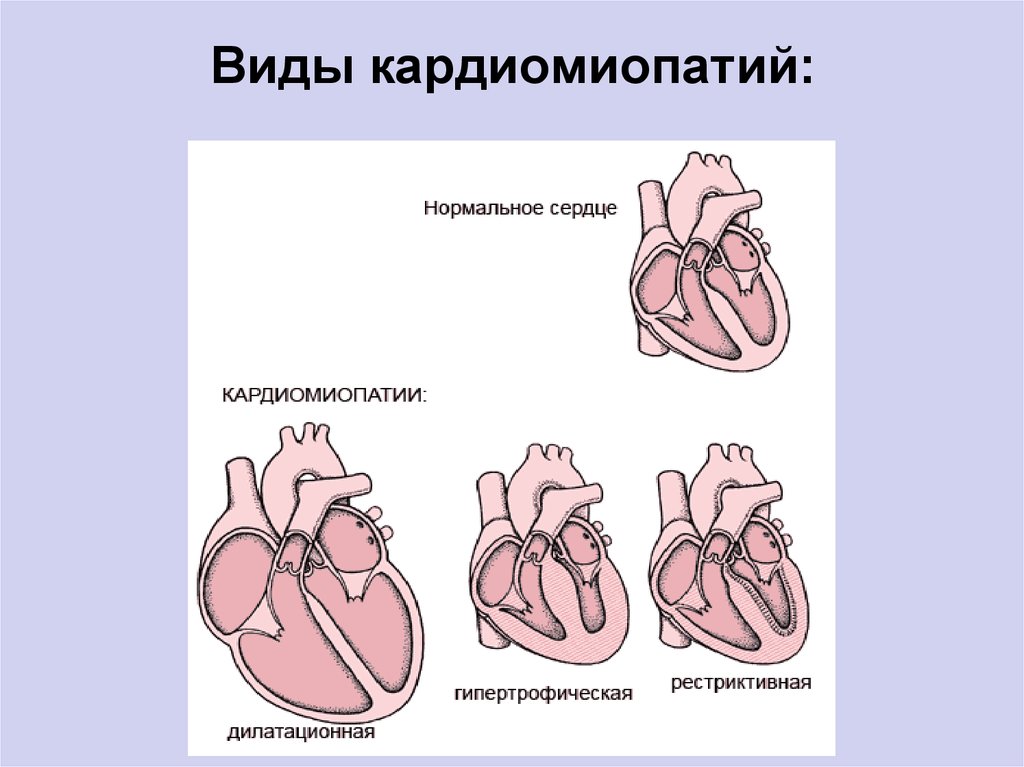 Кардиопатия. Клапаны при кардиомиопатии. При всех видах кардиомиопатий клапаны сердца. Сердечной недостаточности кардиомиопатии. Первичная кардиомиопатия.