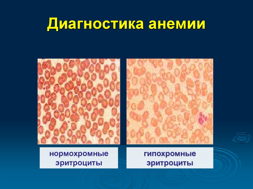 Тесты анемия у детей