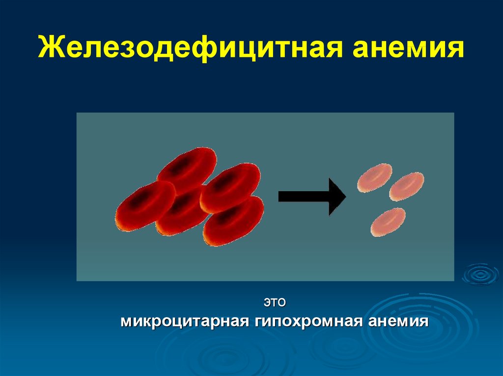 Железодефицитная анемия этиология патогенез картина крови