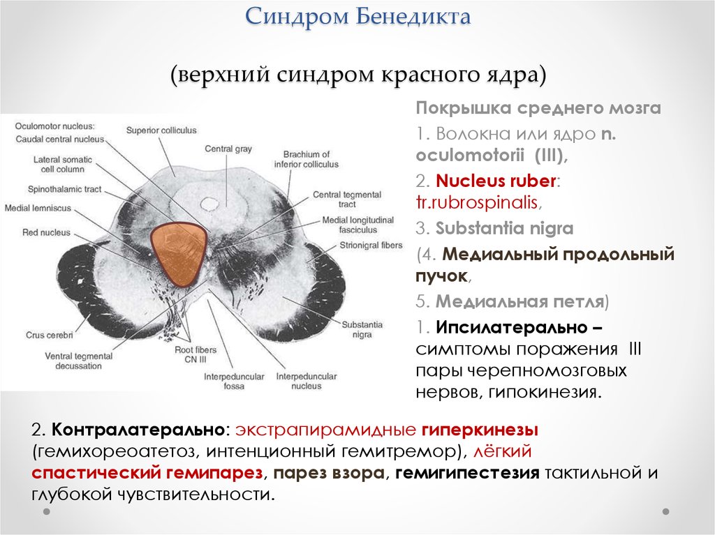 Синдром фовилля. Альтернирующий синдром Бенедикта. Синдром поражения покрышки среднего мозга. Альтернирующий синдром Клода. Альтернирующий синдром Бенедикта Клода Вебера.