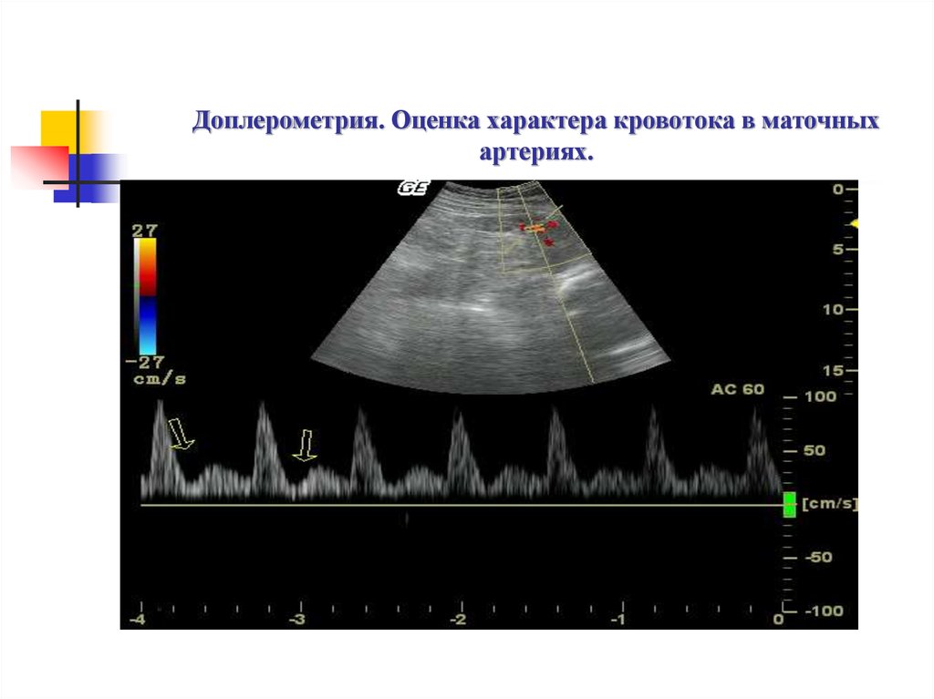 Маточная гемодинамика. Допплерометрия плодового кровотока. Оценка характера кровотока. Кровоток в маточных артериях. Импульсная спектральная допплерография.
