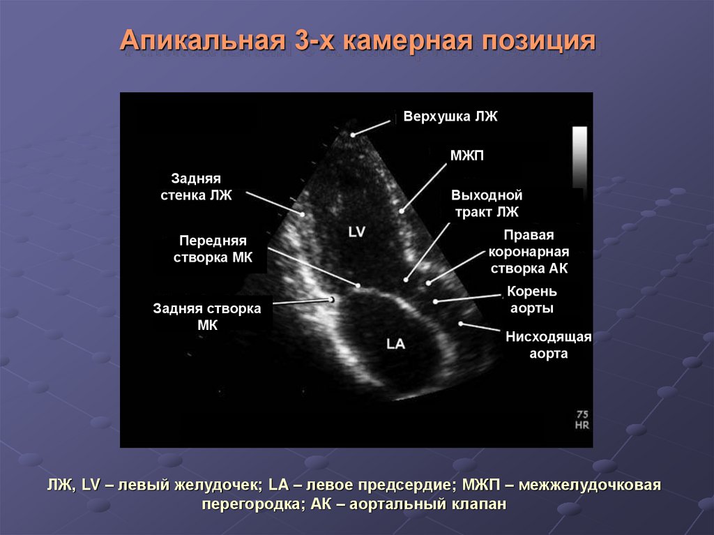 Узи сердца схема