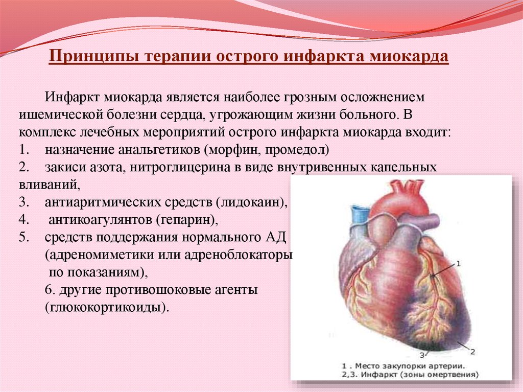 Сердечный ковид. Ишемическая болезнь инфаркт миокарда. ИБС острый инфаркт миокарда. Принципы терапии острого инфаркта миокарда. Острый инфаркт миокарда (ОИМ).