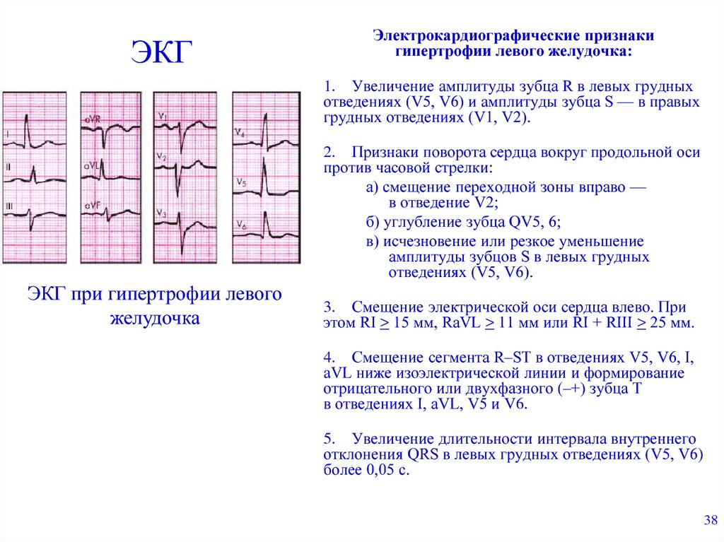 Причины гипертрофии левого желудочка. ЭКГ при артериальной гипертензии 1 стадии.