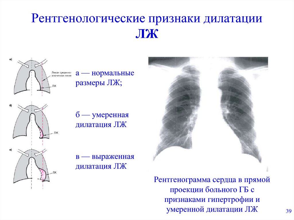 Рентгенологические признаки дилатации ЛЖ