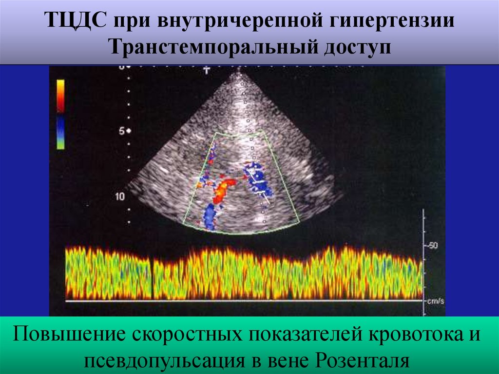 Норма вены галена