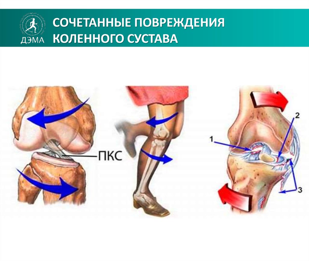 Повреждения мениска коленного сустава как лечить