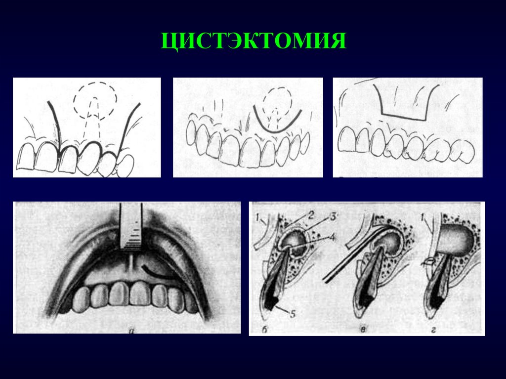 Цистоэктомия. Цистотомия и цистостомия. Операция резекции верхушки корня зуба. Цистотомия кисты челюсти. Цистотомия и цистэктомия этапы.