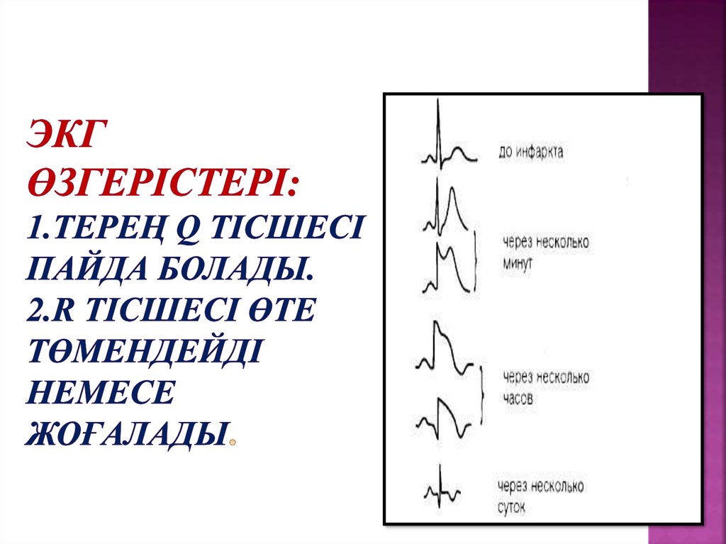 ЭКГ өзгерістері: 1.терең q тісшесі пайда болады. 2.R тісшесі өте төмендейді немесе жоғалады.