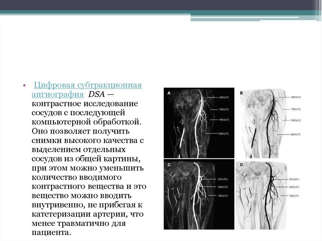 Исследование артерий. Ангиография сосудов нижних конечностей заключение. Аорто артериография нижних конечностей. Цифровая субтракционная ангиография DSA. Ангиография сосудов нижних конечностей протокол исследования.