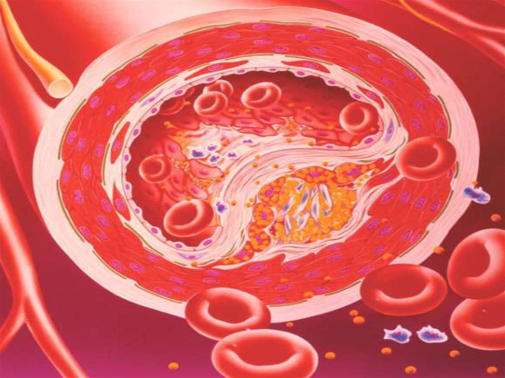 Атеросклероз у взрослого. Атеросклеротические бляшки в сердце.