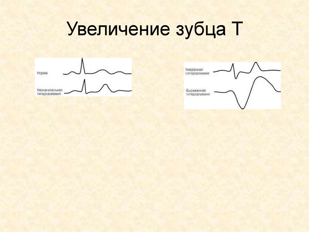 Увеличение зубца т