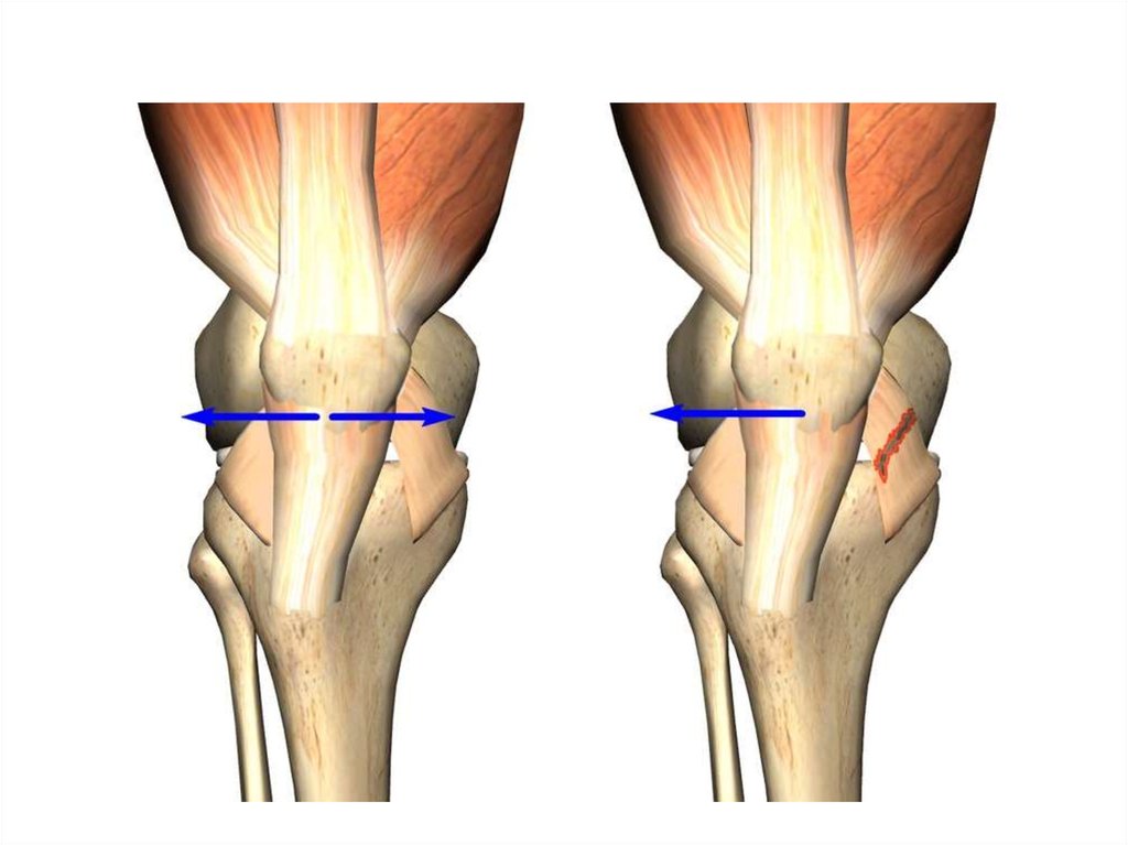 Латеральный разрыв. Дисплазия мыщелка бедренной кости коленного сустава. Медиальный вывих надколенника. Дисплазия латерального мыщелка коленного сустава что это. Латеральный подвывих коленного сустава.
