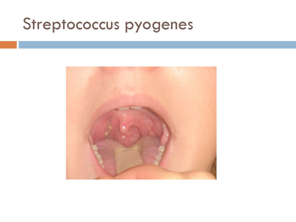 Streptococcus pyogenes