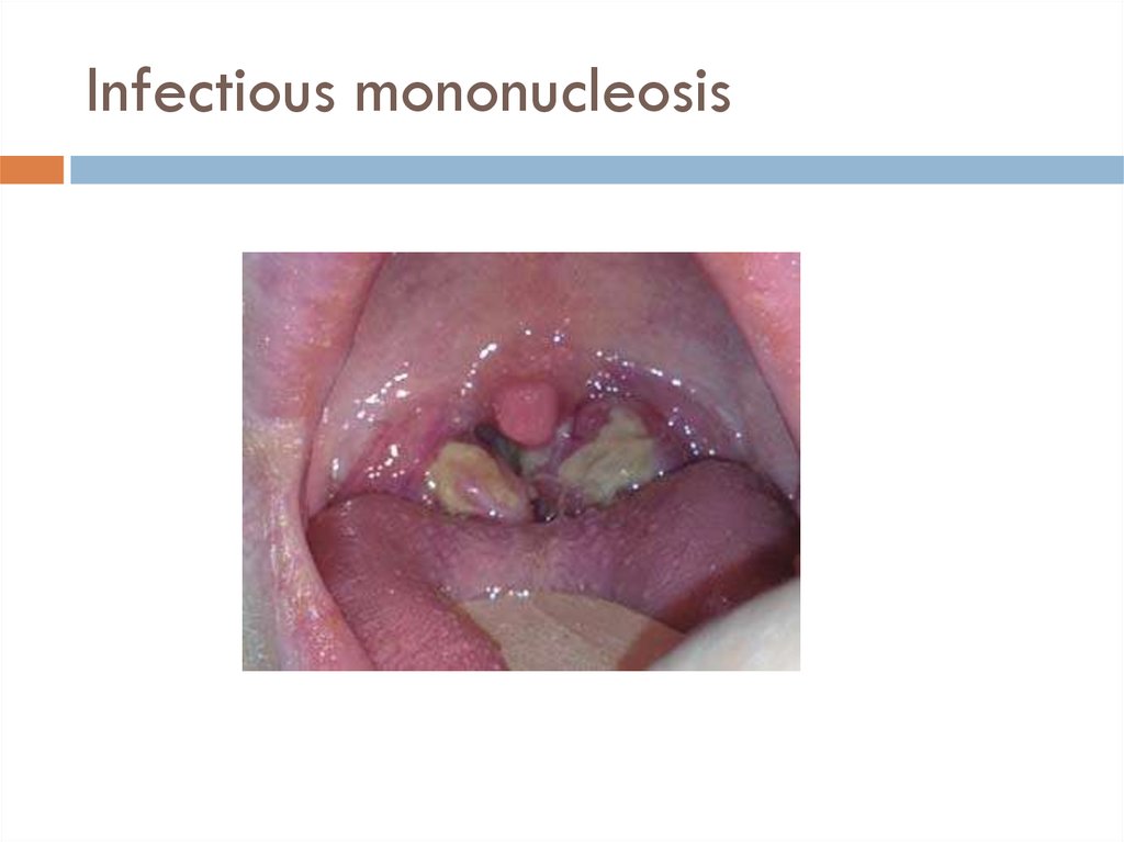 Infectious mononucleosis