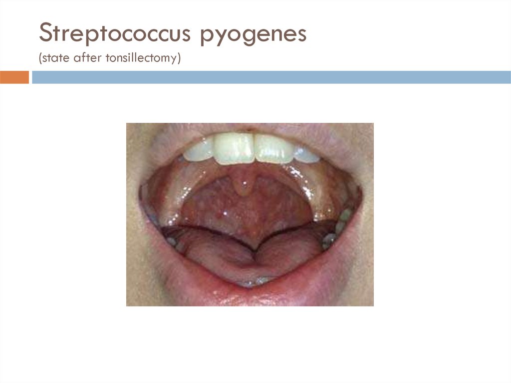 Streptococcus pyogenes (state after tonsillectomy)