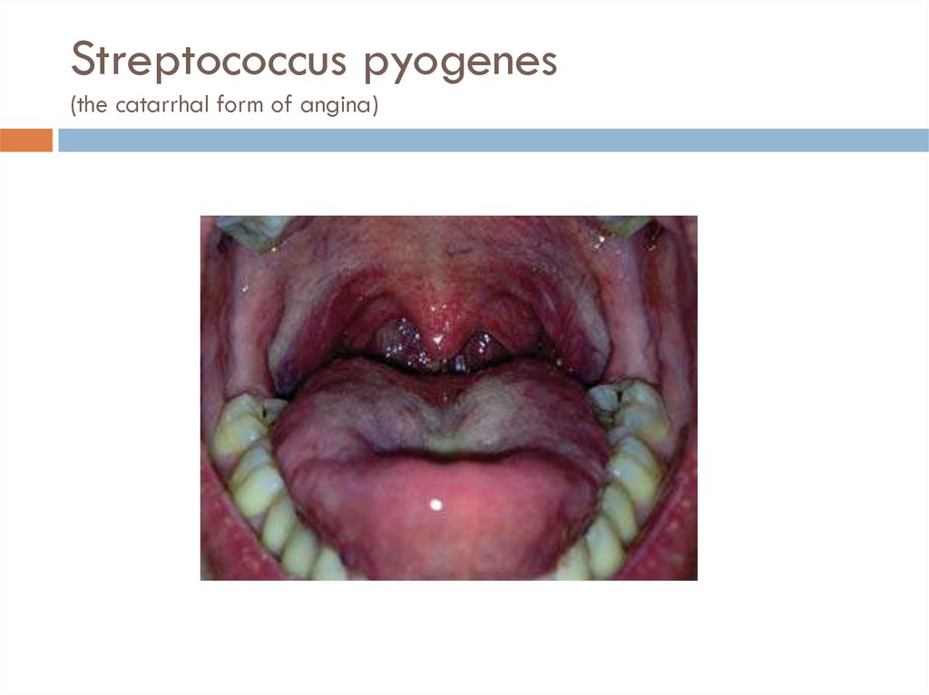 Streptococcus pyogenes (the catarrhal form of angina)