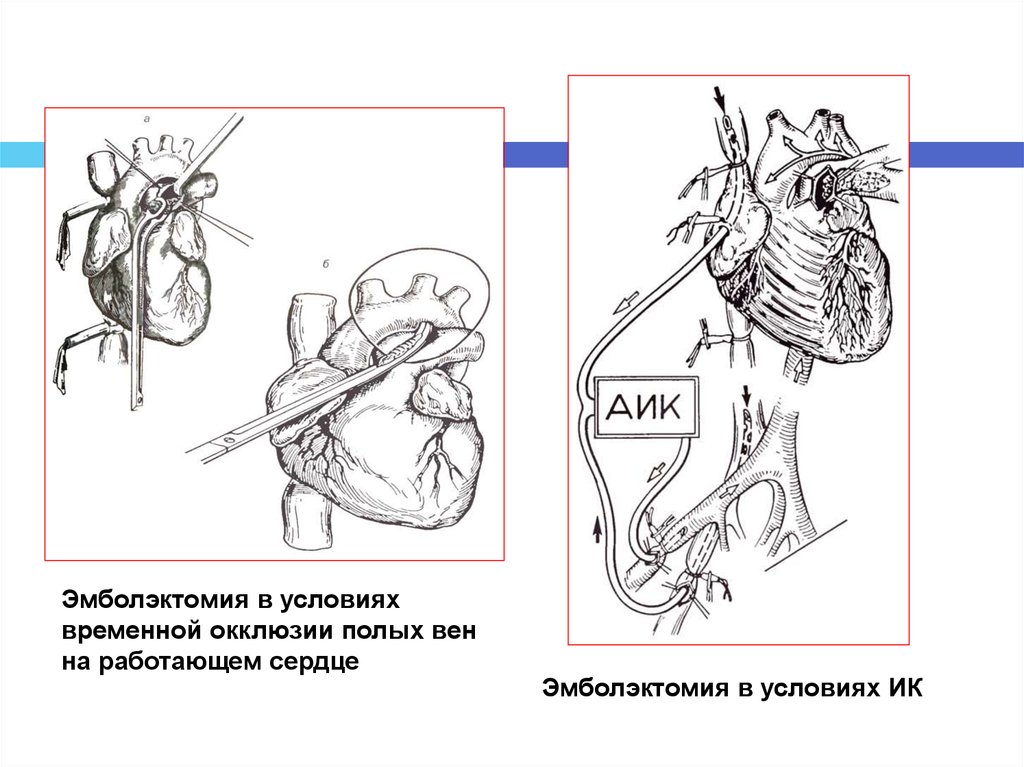 Тромбоэмболия операция. Эмболэктомия легочной артерии. Эмболэктомия из легочной артерии. Операция Тренделенбурга при Тэла. Хирургическая тромбэктомия при Тэла.