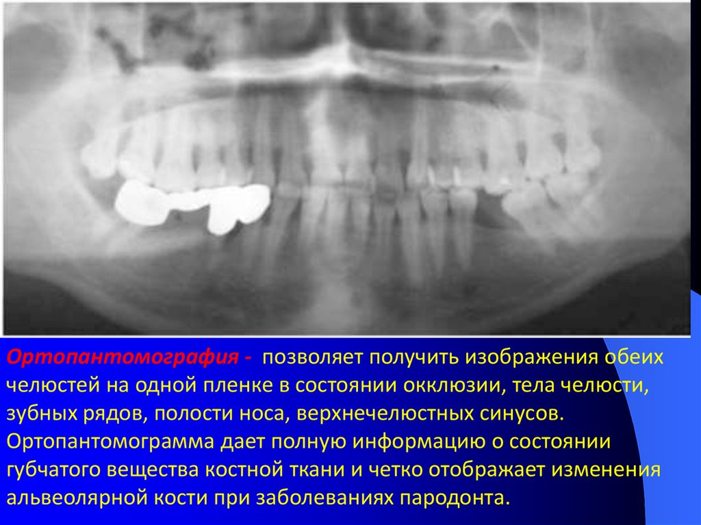 Полная окклюзия. Травматическая окклюзия зубных рядов. Травматическая окклюзия презентация. Травматическая окклюзия рентген. Функциональная окклюзия.