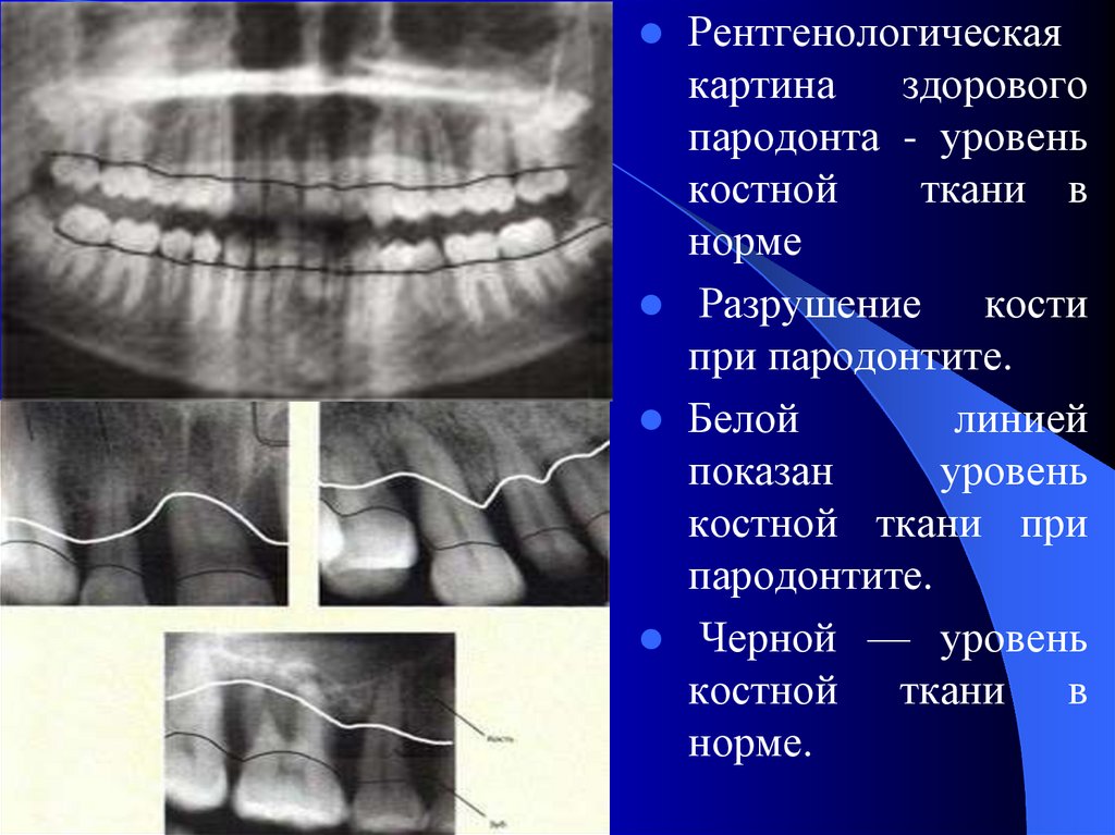 Пародонтит рентгенологическая картина