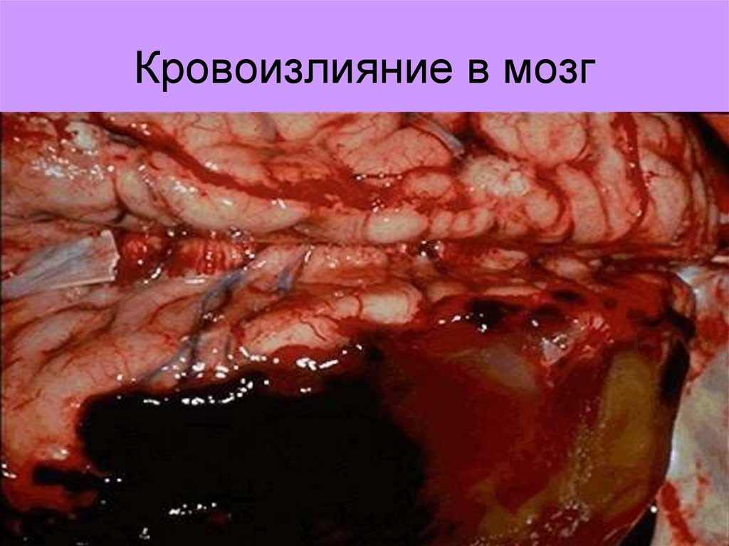 Кровоизлияние в мозг