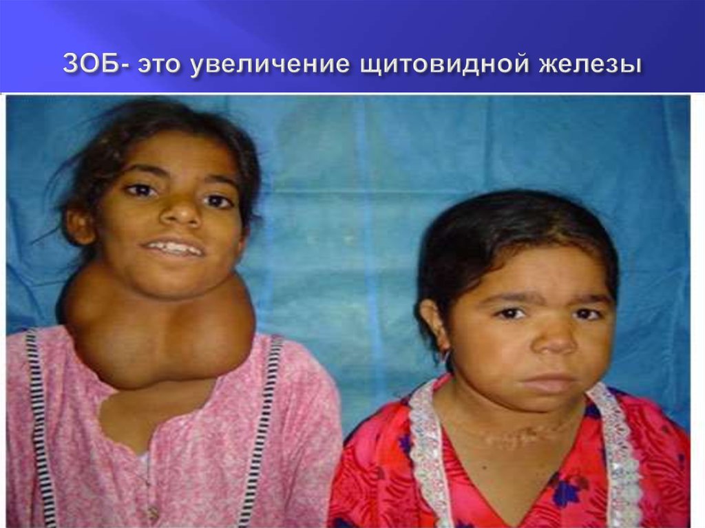 ЗОБ- это увеличение щитовидной железы