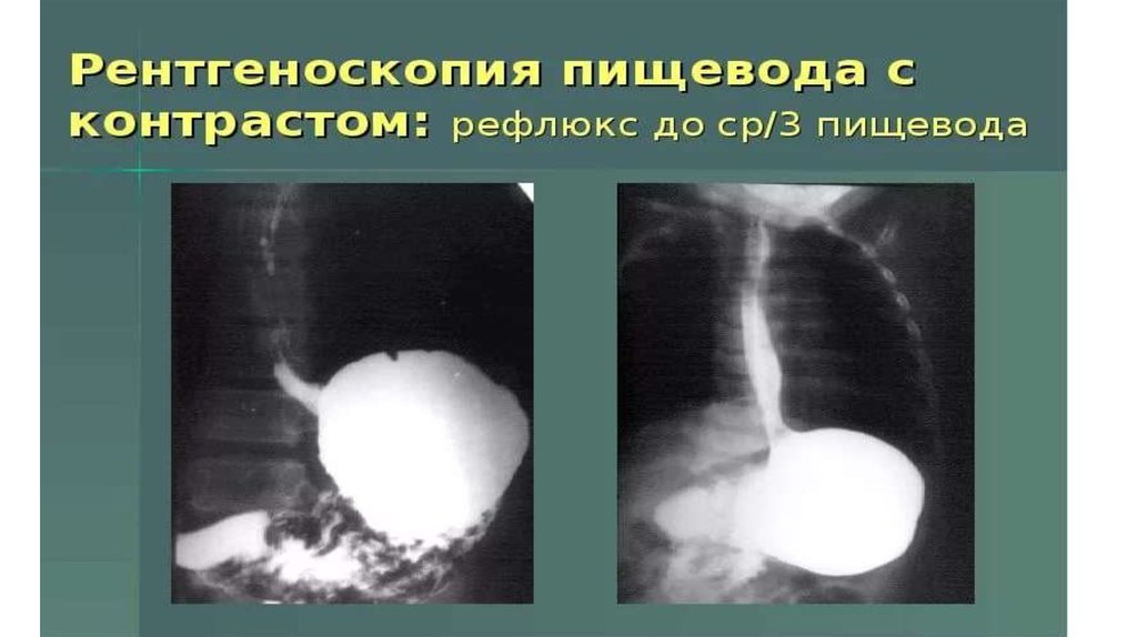 Скопия пищевода. Желудочно пищеводный рефлюкс рентген. ГЭРБ рентгенологические признаки. Рефлюкс желудка рентген. Рефлюкс эзофагит рентген.